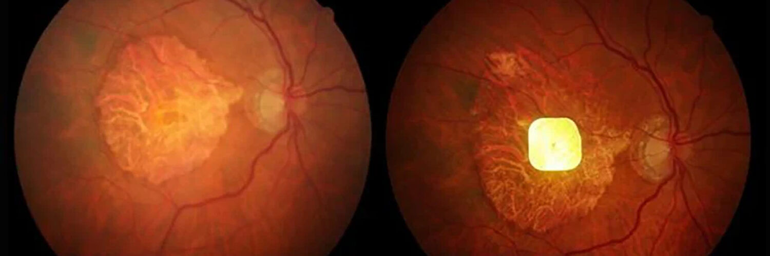 antes y después de la implantación del sensor PRIMA.
